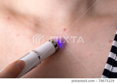 Removing a red pimple on a girl's neck with a cosmetic laser pen, macro Removing a red pimple on a girl's neck with a cosmetic laser pen, macro 78675229