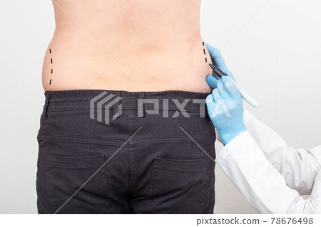 The plastic surgeon makes marks with a marker on the problem areas of the patient's thighs. Fat removal concept with plastic surgery, liposuction 78676498