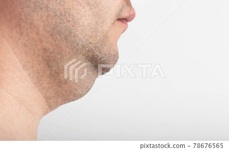 A man has a thick double chin, close-up. Correction and removal of fat from a double chin, plastic surgery. Copy space for text 78676565