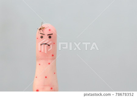 Finger art of man. Concept of human was bitten by mosquito. 78678352