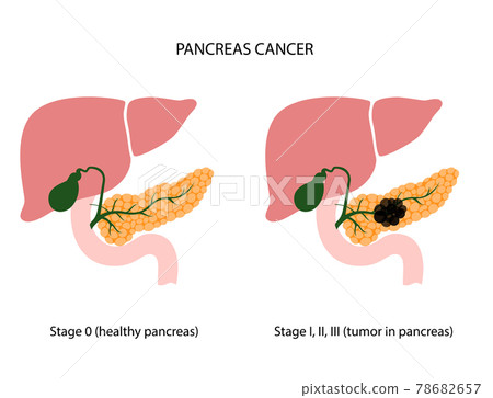 Pancreas disease and cancer 78682657