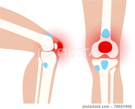 Bursitis inflammation concept Bursitis inflammation concept 78683406