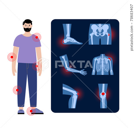 Bursitis icons set Bursitis icons set 78683407