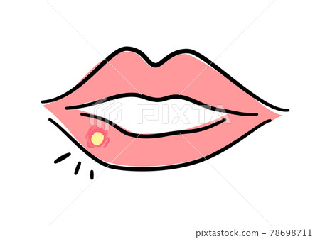 Herpes labialis illustration 78698711