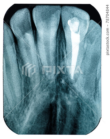 Radiography imaging teeth upper canines root canal Radiography imaging teeth upper canines root canal 78704844