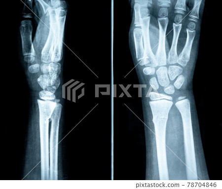 Right hand two positions check roentgenogram film 78704846