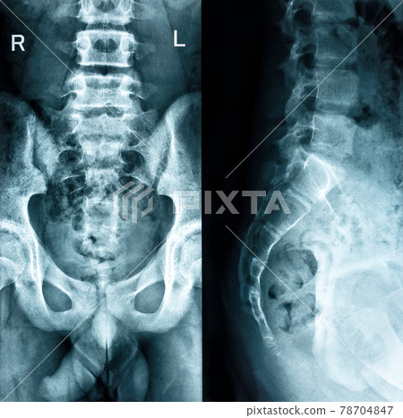 Pelvic bones two positions check roentgenogram film Pelvic bones two positions check roentgenogram film 78704847