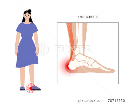 Bursitis inflammation concept 78712350