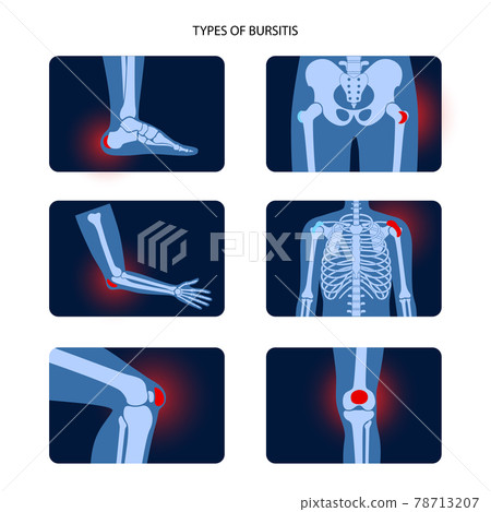 Bursitis icons set 78713207