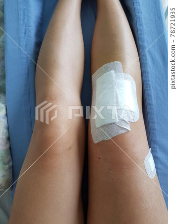 膝蓋受傷的腿 78721935