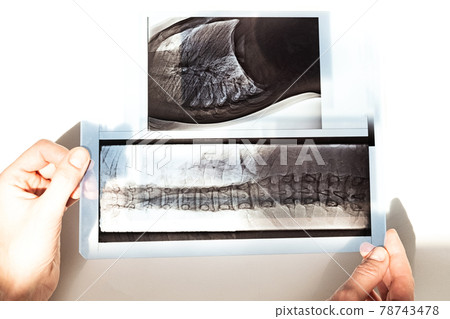 X-ray of the bones of the back of the vertebrae, lungs and chest in case of scoleosis and curvature of the spine. X-ray of the bones of the back of the vertebrae, lungs and chest in case of scoleosis and curvature of the spine. 78743478