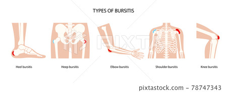 Bursitis icons set Bursitis icons set 78747343