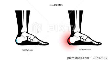 Bursitis inflammation concept 78747367