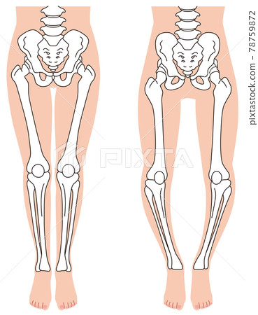 骨盆和骨架 O 型腿骨架 骨盆扭曲 78759872