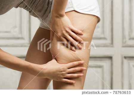 Thigh cellulite / young woman Thigh cellulite / young woman 78763633