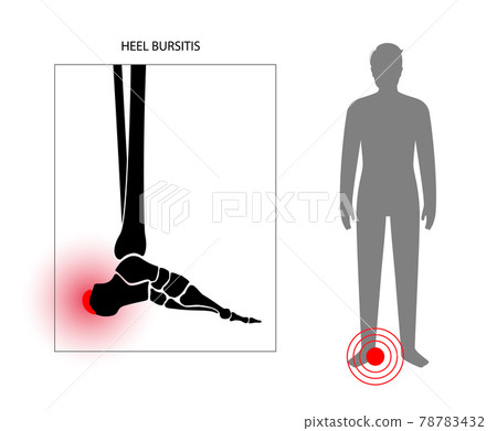 Bursitis inflammation concept 78783432