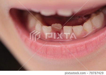 Regeneration from deciduous teeth to permanent teeth Regeneration from deciduous teeth to permanent teeth 78787429