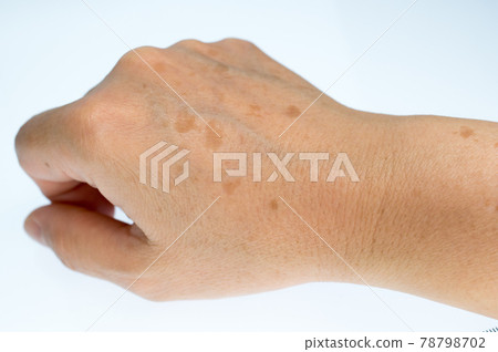 The right hand of a woman suffering from stains on the back of her hand 78798702