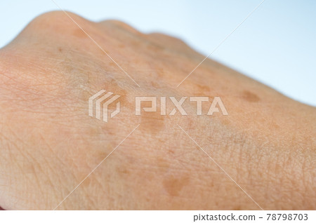 The right hand of a woman suffering from stains on the back of her hand 78798703