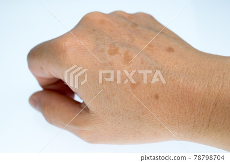 The right hand of a woman suffering from stains on the back of her hand 78798704