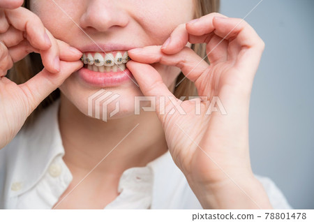 Close-up portrait of a red-haired girl touching braces. Young woman corrects bite with orthodontic appliance. 78801478