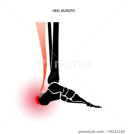 Bursitis inflammation concept 78810160