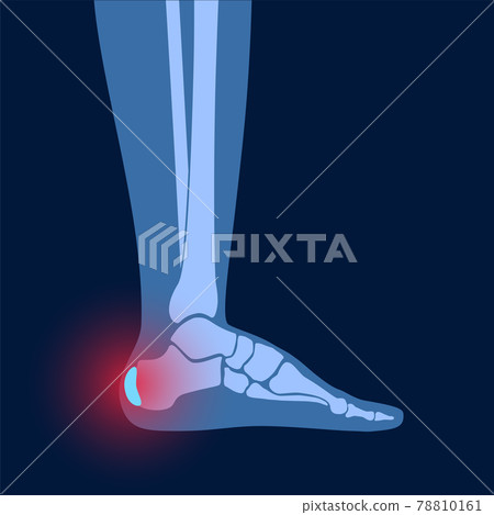 Bursitis inflammation concept 78810161