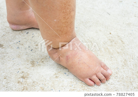 Feet of people with diabetes, dull and swollen. Due to the toxicity of diabetes placed on concrete floor 78827405