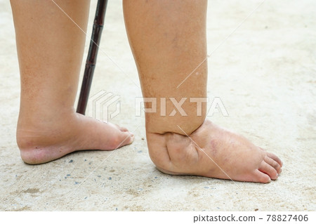 Feet of people with diabetes, dull and swollen. Due to the toxicity of diabetes placed on concrete floor 78827406