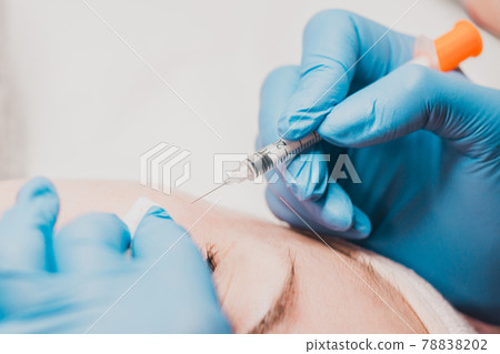 Miliums on the face, removal of hardened and mature milia by a beautician. 78838202