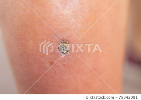 Pimple Folliculitis on buttock caused by infection from bacteria, yeast, fungus, irritation of hair follicles, or blockage of hair follicles. Pimple Folliculitis on buttock caused by infection from bacteria, yeast, fungus, irritation of hair follicles, or blockage of hair follicles. 78842081