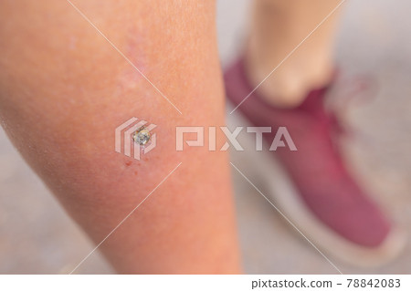 Pimple Folliculitis on buttock caused by infection from bacteria, yeast, fungus, irritation of hair follicles, or blockage of hair follicles. 78842083