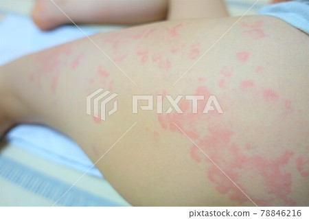Children with urticaria Jinmasin Children with urticaria Jinmasin 78846216