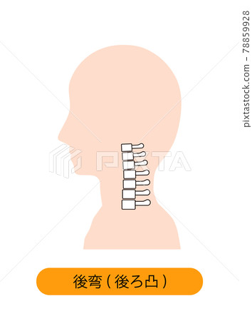 頸椎後凸的頸骨圖像 頸椎後凸的頸骨圖像 78859928