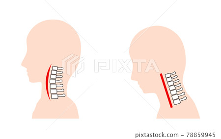 Image of straight neck (smartphone neck) and normal neck bone 78859945