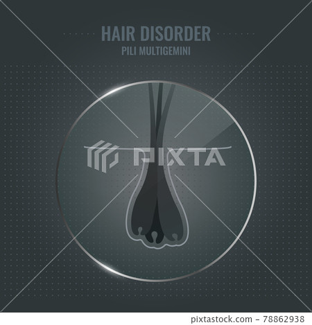 Pili multigemini hair disorder in close up Pili multigemini hair disorder in close up 78862938