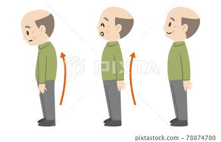 Before and after of a senior man with a bent back 78874780