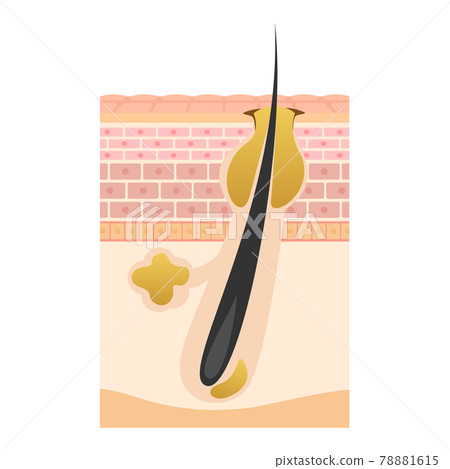 Skin condition Cross section of skin layer Oily skin pores 78881615
