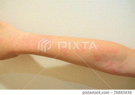 Children with urticaria Jinmasin Children with urticaria Jinmasin 78883836