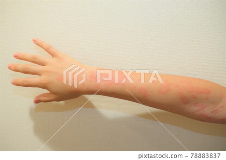 Children with urticaria Jinmasin Children with urticaria Jinmasin 78883837