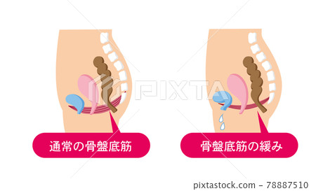 Mechanism of urine leakage Medical illustration of pelvic floor muscles Mechanism of urine leakage Medical illustration of pelvic floor muscles 78887510