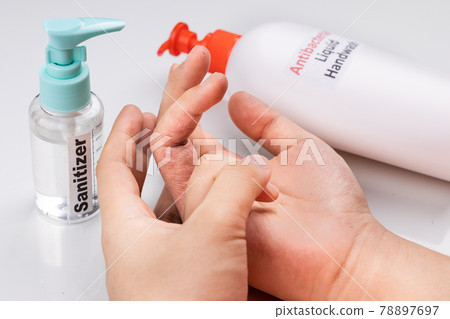 Dry skin on finger with bottle of antibacterial liquid handwash and hand sanitizer. Frequent hand washing causes skin dryness Dry skin on finger with bottle of antibacterial liquid handwash and hand sanitizer. Frequent hand washing causes skin dryness 78897697