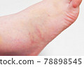 Bruise on the foot 78898545