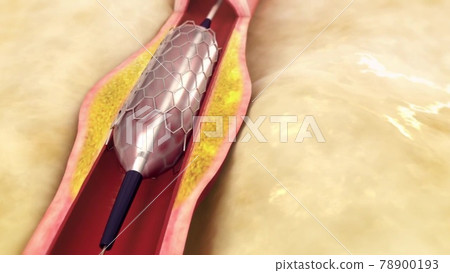 Angio Therapy. Stent placement in the artery. Angio Therapy. Stent placement in the artery. 78900193