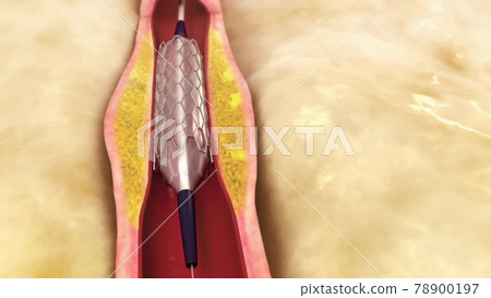 Angio Therapy. Stent placement in the artery. Angio Therapy. Stent placement in the artery. 78900197