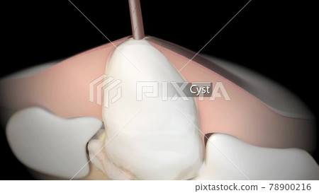 Acne And Pimples, Stages Of Development, anatomy medical illustration Acne And Pimples, Stages Of Development, anatomy medical illustration 78900216
