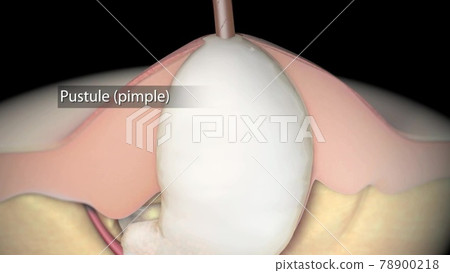 Acne And Pimples, Stages Of Development, anatomy medical illustration 78900218