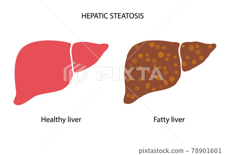 Liver disease concept 78901601
