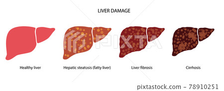 Liver disease concept 78910251