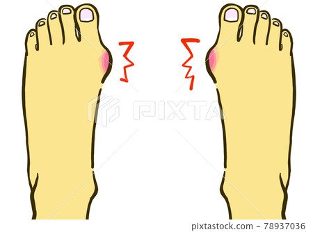 因拇外翻而受傷的腳的線條圖插圖 78937036